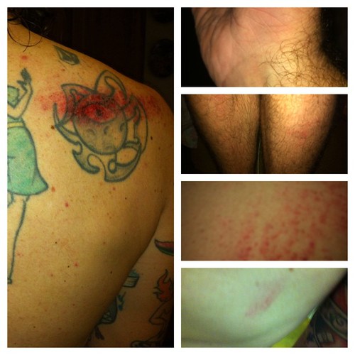 Minor injury report: road rash on shoulder and back, sprai… | Flickr