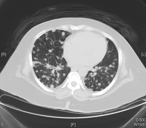 Metastatic colonic adenocarcinoma - CT scan -  Case 263