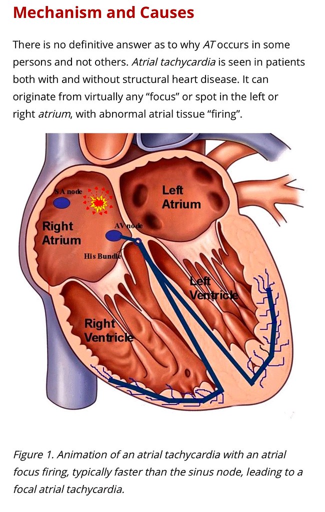 Atrial Supra Ventricular Tachycardia . Atrial SVT | Flickr