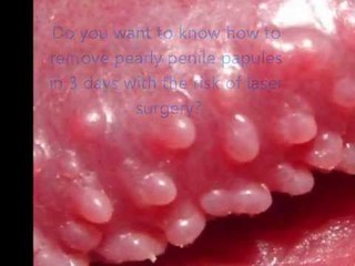 Pearly papules pink Flesh
