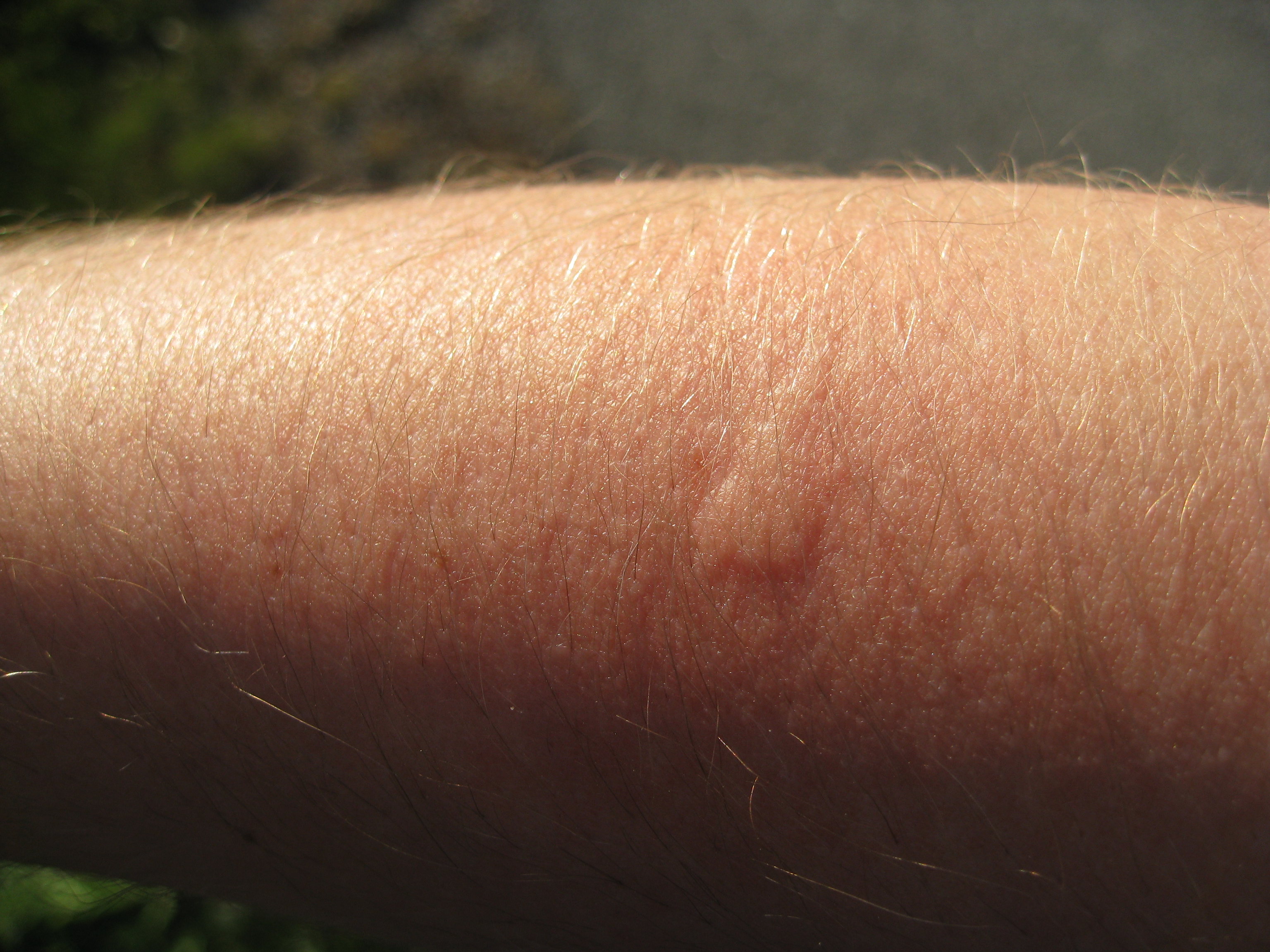 First mosquito bite 2010, 15 minutes later