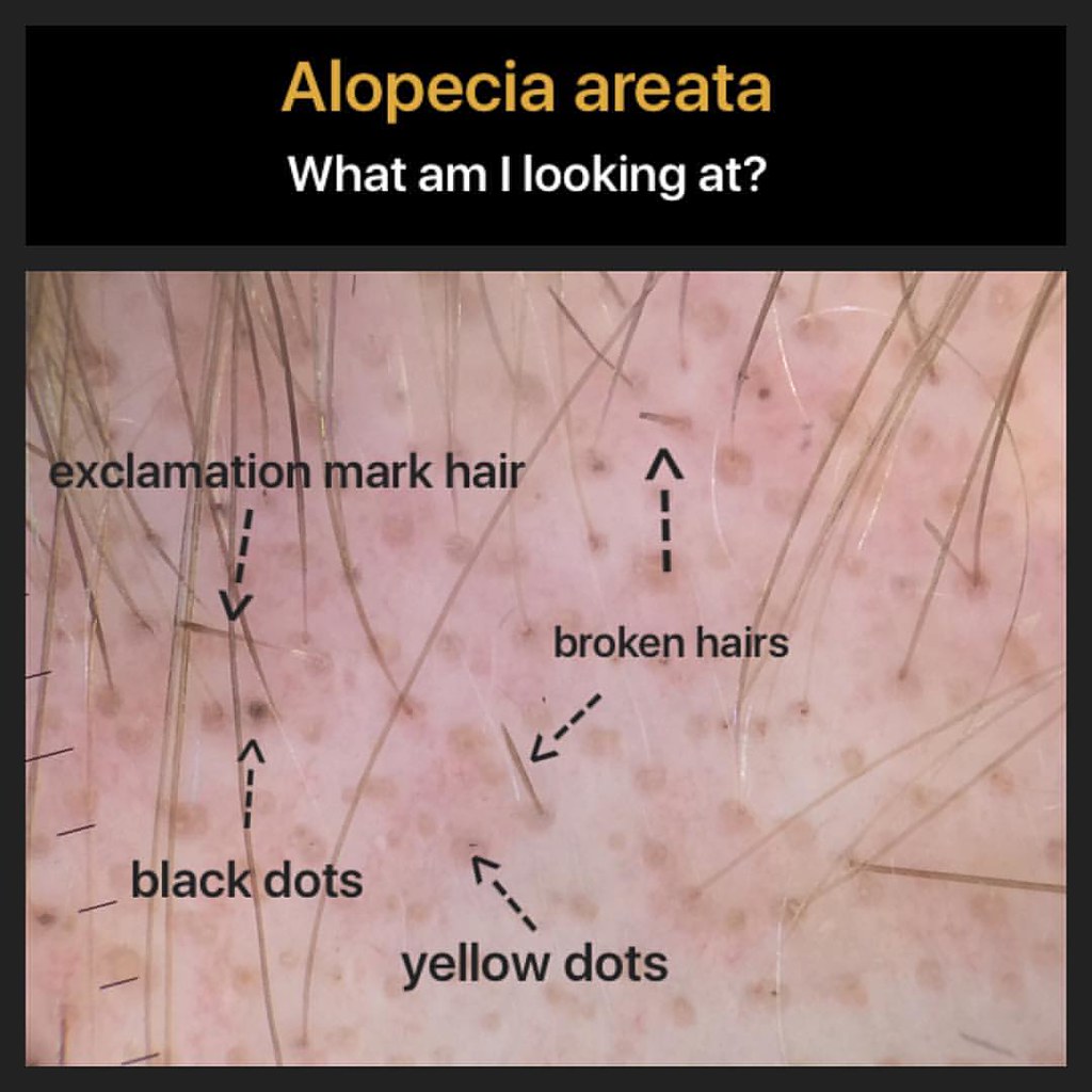 Alopecia areata (AA) is an autoimmune condition. Many chan… | Flickr