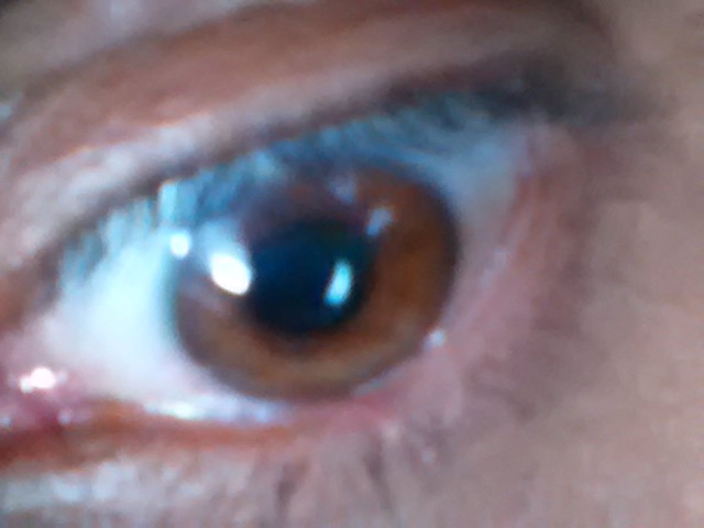 Dilated Pupil