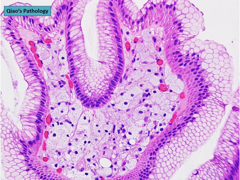 Qiao's Pathology: Gastric Xanthoma (Xanthelasma ...