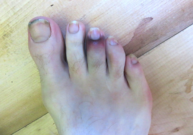 stubbed toe(2015)