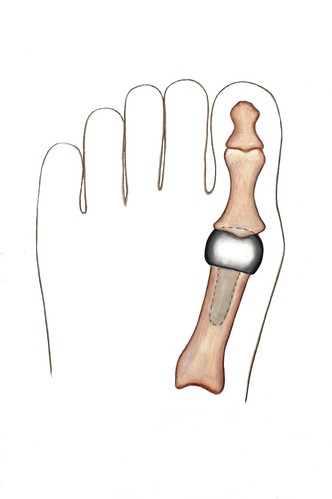 Metal Toe Implant | by Richard Scherzer
