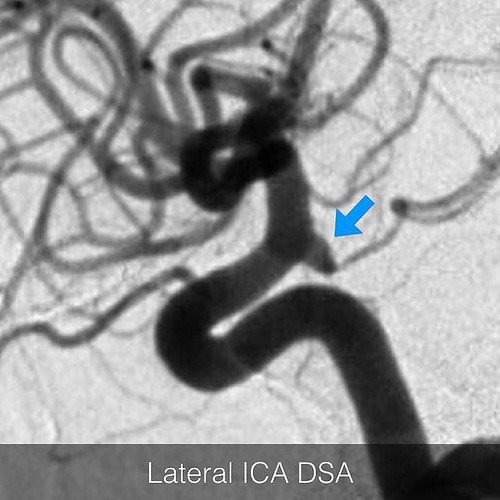 This is a PCOM infundibulum and not an aneurysm. You can t… | Flickr