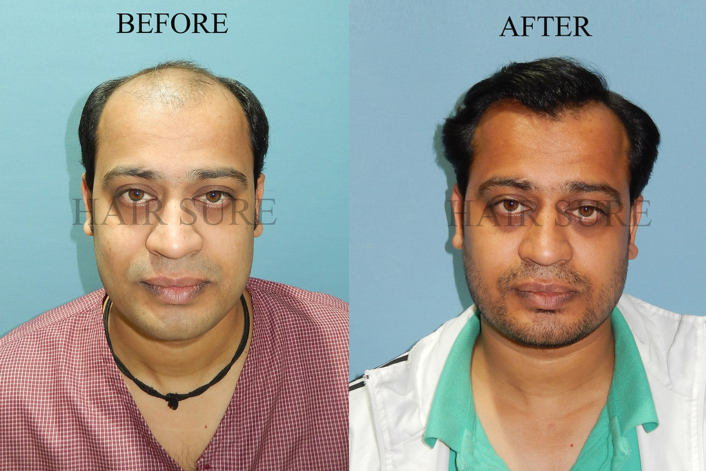 Body Hair Transplant In Hyderabad | Best Body Hair Transpl… | Flickr