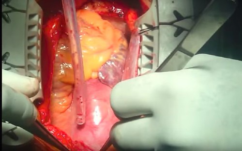 Aortic Dissection Surgery Procedure - 3 by Heart And Aorta, Aortic Dissection Surgery Procedure
Aortic Dissection Surgery, by Dr. Dr John E V.
The man behind