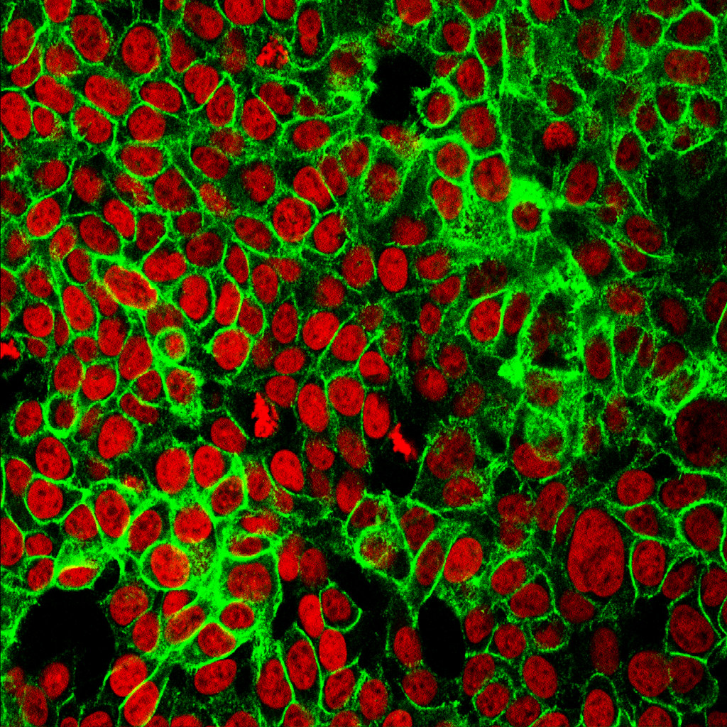 Image result for cancer cells