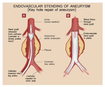 Endovascular Stenting Of Aneurysm - Heart and Aorta Image Gallery by Heart And Aorta, [Image courtesy: ‘Heart and Aorta’]

'Heart and Aorta' [<a href="http://www.heartandaorta.com" rel="