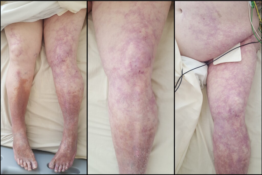 Marbrures, AOMI et cicatrice d'érysipèle | Patient de 70 ans… | Flickr